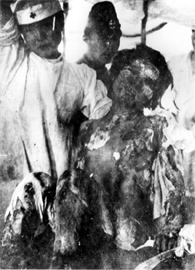 foto: victima de la bomba atómica de Nagasaki
